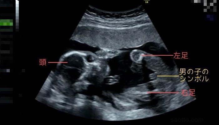 胎児エコーで性別がわかるのはいつ頃 男の子と判明した時の超音波画像も紹介 さおっとらいふ